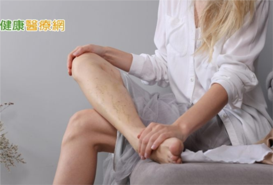 小腿容易痠麻腫脹、傍晚水腫　心臟科醫：是血管疾病！