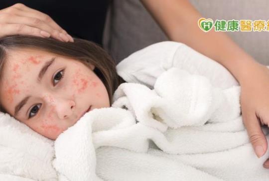 長幼同患病 一家雙頭燒 疫情降溫！預防水痘、皮蛇等高傳染疾病不能等