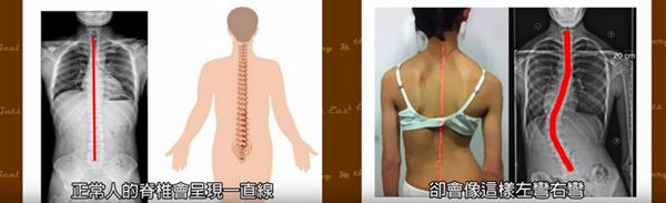脊椎3.jpg